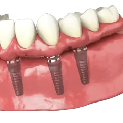 Dettaglio di una protesi dentale fissa su impianti, simile alla protesi Toronto, con denti bianchi e gengive rosa.