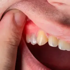 Ropa w dziąśle: Co robić? Szybka ulga i kiedy do dentysty