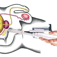 Illustration zeigt eine Biopsie der Prostata. Die Frage, wie lange dauert das Ergebnis einer Biopsie, ist hier relevant.