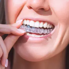 Mujer se coloca un alineador transparente. Para mantenerlos impecables y evitar que el Invisalign amarillo, es clave una buena higiene.