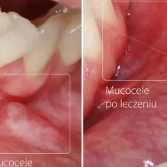 Przed i po leczeniu torbieli w jamie ustnej. Widoczne zmiany na błonie śluzowej.