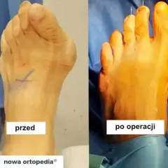 Ortopeda od haluksów: Kto leczy? Jak wygląda leczenie?