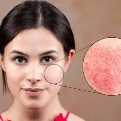 Rumień, pajączki? Rozpoznaj objawy cery naczynkowej i działaj!
