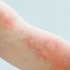Ramię z widocznymi, rozległymi zmianami rumieniowymi, przypominającymi pokrzywkę lub reakcję alergiczną.