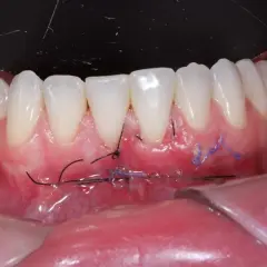 Boca con injerto libre de encía y suturas visibles. El tejido gingival se ve enrojecido y con puntos de sutura negros y morados.
