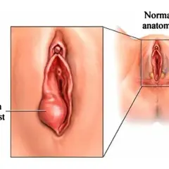 Ilustracja pokazuje powiększony gruczoł Bartholina z torbielą, w porównaniu do normalnej anatomii.