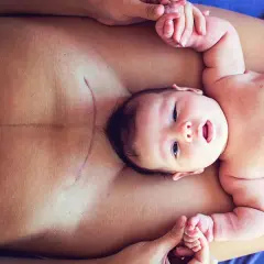 Ein Baby liegt auf dem Bauch seiner Mutter, deren Kaiserschnittnarbe sichtbar ist. Mögliche Symptome eines Geburtstraumas nach Kaiserschnitt können hier thematisiert werden.