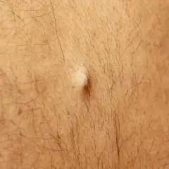 Mały, białawy kaszak na skórze, otoczony włoskami.