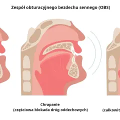 Ilustracja pokazuje normalne oddychanie, chrapanie (częściowa blokada dróg oddechowych) i bezdech senny (całkowita blokada dróg oddechowych), wyjaśniając objawy OBS.