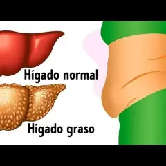 Síntomas del hígado graso: ¿Estás ignorando señales alarmantes?
