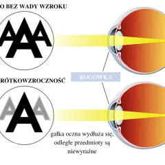 Oko z krótkowzrocznością: światło skupia się przed siatkówką, przez co odległe przedmioty są niewyraźne. Oko bez wady widzi ostro.