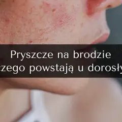 Od czego pryszcze na twarzy? Odkryj prawdziwe przyczyny i porady