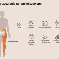 Ilustracja przedstawia przyczyny zapalenia nerwu kulszowego: ciążę, nadwagę, choroby kręgosłupa, cukrzycę, zmiany związane z wiekiem, urazy pleców i siedzący tryb życia.