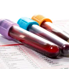 Probówki z krwią na tle formularza badań. Widać m.in. pozycję CRP, co to jest, jest kluczowe w diagnostyce.