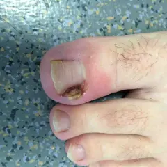 Gros plan d'un ongle incarné au pied, présentant une inflammation et une légère infection.