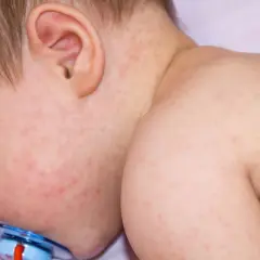 Bebé con sarpullido por fiebre en la cara y el cuello. Pequeñas manchas rojas cubren su piel, indicando una posible enfermedad infantil.