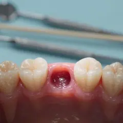 Jak usunąć ropę na dziąśle? Domowe triki i pilna wizyta u dentysty