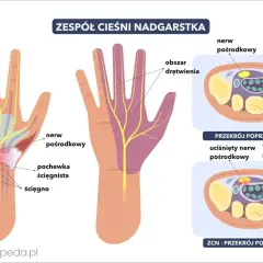 Mrowienie ręki? Cieśnia nadgarstka: Kto diagnozuje, jak leczyć?