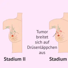 Illustrationen zeigen Stadien von Brustkrebs, von Stadium I (kleiner Tumor) bis Stadium IV (Metastasen). Die Brustkrebs Prognose verschlechtert sich mit jedem Stadium.
