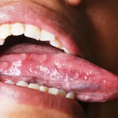 Boca abierta mostrando la lengua con varias llagas blancas y rojas, indicando un problema de llagas en la lengua.