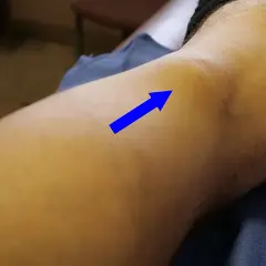 Ginocchio con freccia blu che indica un'area gonfia, possibile muscolo popliteo infiammato. Esercizi per il recupero.