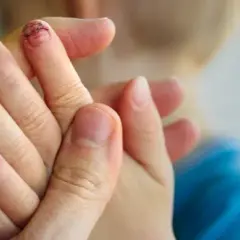 Utrata paznokcia: Pierwsza pomoc, pielęgnacja i odrastanie poradnik