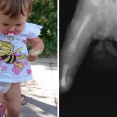 Rentgen nóżek niemowlaka z widocznym strzelaniem kości. Dziecko w pieluszce i koszulce z pszczółką Mają.