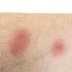 Hausstaubmilben Allergie Symptome: So erkennen Sie die Anzeichen
