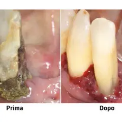 Prima e dopo: gengive infiammate e denti con tartaro, poi gengive sane. La piorrea può portare alla caduta dei denti.