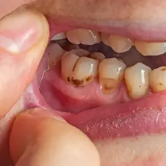 Denti cariati e gengive infiammate, possibili cause di alito cattivo dallo stomaco.