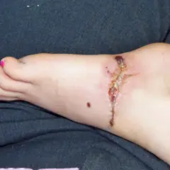 Stopa z raną pooperacyjną, która zaczyna wykazywać objawy gangreny. Widoczne są zaczerwienienie, obrzęk i ciemne przebarwienia.