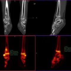Co to jest SUV max i dlaczego jest kluczowy w diagnostyce?