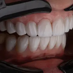 Piękne, białe zęby po leczeniu kanałowym. Zastanawiasz się, ile wytrzyma ząb po leczeniu kanałowym? Dbanie o higienę i regularne wizyty u dentysty to klucz do długowieczności.