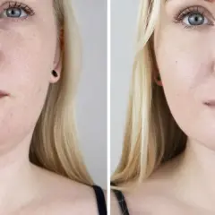 Före- och efterbilder visar resultat av fettfrysning för att minska dubbelhaka.