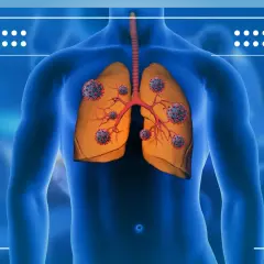 Ilustracja przedstawia płuca z wirusami. Rak płuc może objawiać się neurologicznie.
