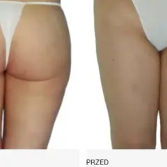 Endermologia: Jak często? Odstępy (2-3x/tydz.) dla trwałych efektów