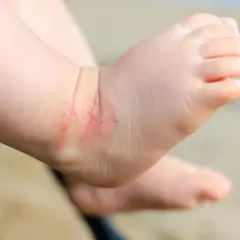 Czerwone, podrażnione miejsca na stopie dziecka.