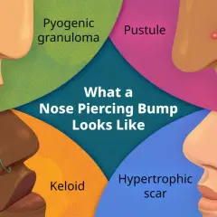 Ilustracja pokazuje różne problemy z kolczykiem w nosie: ziarniniak ropotwórczy, krostę, keloid i bliznę przerostową.