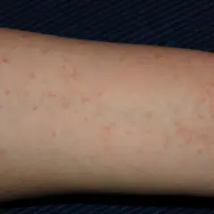 Braccio con eruzione cutanea rossa e pruriginosa, simile a una falsa scabbia.