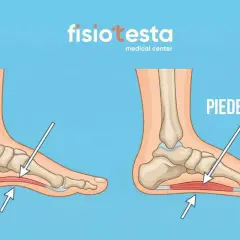 Confronto tra un piede normale e un piede piatto, evidenziando la pronazione del piede e l'appiattimento dell'arco plantare.