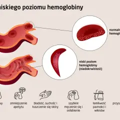 Niski poziom hemoglobiny (niedokrwistość) objawia się bólem głowy, bladością, suchością skóry i szybkim męczeniem.