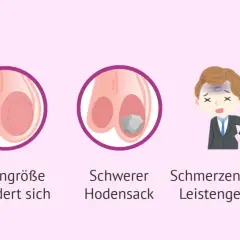 Illustration zeigt einen Hoden mit einem Knubbel, veränderte Hodengröße, einen schweren Hodensack, Schmerzen in der Leistengegend und empfindliche Brüste.