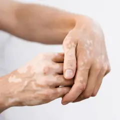 Dłonie z plamami bielactwa nabytego od stresu. Jasne przebarwienia na skórze tworzą nieregularne wzory.