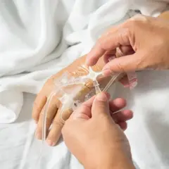 Ręce pielęgniarki podłączają kroplówkę do portu do podawania chemii na ręce pacjenta.