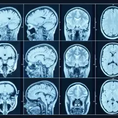 Czy rezonans wykryje choroby psychiczne? Prawda o MRI głowy