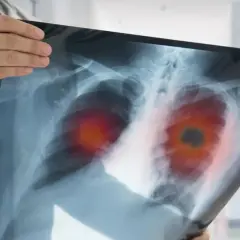 Die alarmierenden Symptome des Bronchialkarzinoms erkennen und verstehen