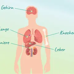 Illustration zeigt menschlichen Körper mit markierten Organen: Gehirn, Lunge, Nebenniere, Knochen, Leber. Mögliche Metastasierungsorte bei Lungenkrebs.
