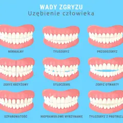Jak długo nosi się aparat na zęby? Pełny przewodnik ortodonty