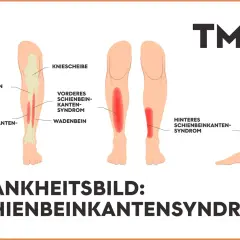 Illustration zeigt das Schienbeinkantensyndrom (shin splint) mit roten Schmerzbereichen am Schienbein und Wadenbein.