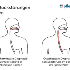 Illustrationen zeigen zwei Arten von Dysphagie: Oropharyngeale Dysphagie (Mund/Rachen) und Ösophageale Dysphagie (Speiseröhre).